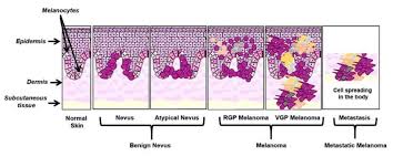 Mika, zhou ke yu, patrick, liu zhang, lai lai, lu ding hao, lelush xie xing yang, rong yao, lin yu xiu, qu bo yu, xu shao lan wang. Ijms Free Full Text The Mirnas Role In Melanoma And In Its Resistance To Therapy Html