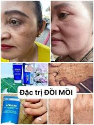 Ai bị đồi mồi, đốm đen,nâu thì liên hệ với em nhé 🌸Em mới về ít Kem trị  ĐỒI MỒI của Nga 👉SP chất lượng chỉ bôi lên vị trí cần tẩy