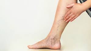L'embolia polmonare e la trombosi venosa profonda. Trombosi Venosa I Nuovi Anticoagulanti Sono Sempre Piu Efficaci Ok Salute