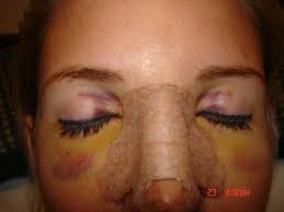 Rhinoplasty Journal Septoplasty And Turbinate Reduction Surgery Rhinoplasty Reduction Surgery Surgery