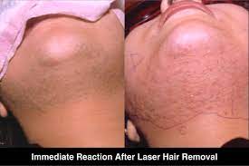 The light is absorbed by the melanin contained in the hair which acts as an intermediary for transmitting damaging heat inside the follicle. Immediate Reaction After Laser Hair Removal Skin Laser Centre