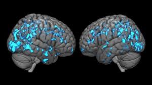 Tremors are common, but the disorder. Deep Brain Stimulation Eases Parkinson S Disease Symptoms By Boosting Dopamine