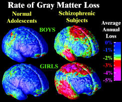 It has been though for over a century that schizophrenia is a disorder of the brain. Mapping Adolescent Brain Change Reveals Dynamic Wave Of Accelerated Gray Matter Loss In Very Early Onset Schizophrenia Pnas