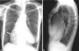 Image result for Restrictive Cardiomyopathy