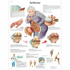 Arthrose