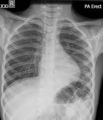 In left upper lobe collapse, the superior segment of the left lower lobe, which is positioned between the aortic arch and the collapsed left upper lobe, is. Left Lower Lobe Pneumonia Radiology Case Radiopaedia Org