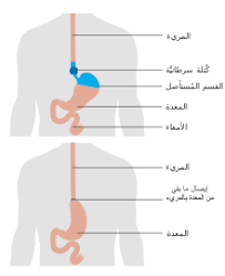 استئصال المريء ويكيبيديا