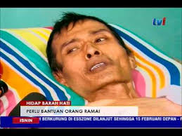 Metastasis adalah situasi dimana kanser telah merebak ke bahagian badan yang lain. Pengidap Kanser Tahap 4 Rayu Bantuan Orang Ramai 30 Jan 2017 Youtube