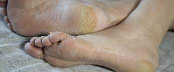 Może być spowodowane uszkodzeniem nerwów obwodowych oraz naczyń stopy.pojawiające się objawy to najczęściej: Stopa Cukrzycowa Przyczyny Objawy Zapobieganie Jak Pielegnowac Stope Cukrzycowa Portal Doz Pl