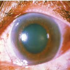 The pressure builds up particularly in the posterior. Acute Angle Closure Glaucoma Secondary To Choroidal Hemorrhage Note C Download Scientific Diagram