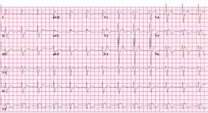 Brugada Syndrome Wikipedia