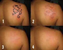 Laser Tattoo Removal In Birmingham Al Cahaba Derm