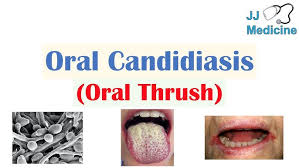 Image result for Candidiasis