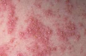 Psoriasis (countable and uncountable, plural psoriases). Psoriasis Etiology Symptoms And Signs Treatment Erkrankungen Der Haut Msd Manual Profi Ausgabe