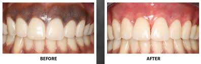 Techniques For Laser Gum Bleaching Gum Bleaching Discolored Gums Dental Laser