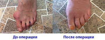 как лечить косточку на ноге в домашних условиях отзывы Kak Ubrat Kostochku Na Bolshom Palce Nogi Travmasport Com Ua