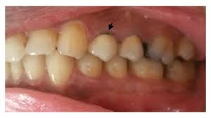 According to an estimate made by costhelper, the price range of dental crowns per tooth today can be as follows: Gold Crown Tooth Cost And Comparison To Porcelain
