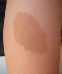 Birthmark On Leg Meaning How Are Birthmarks Caused Types Of Birthmarks And How To Lighten Them At Home Click Below Link To Find Out How Birthmark How To Fade Coconut Oil Hair Mask Diy