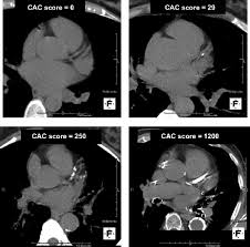 Aug 19, 2019 · depending: Calcium Score Screening What It Is Who Should Get It Results