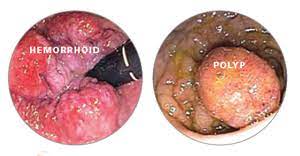 The symptoms of hemorrhoids (also called piles) and bowel cancer can be quite similar but do not have the same fatal results. Understanding Minor Rectal Bleeding Gastroenterologist Mount Pleasant Sc Patient Education Library