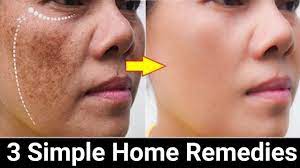 Maybe you would like to learn more about one of these? Remove Face Pigmentation Naturally Youtube