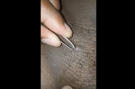 If you pick at the skin or use tweezers to yank the ingrown end out, you are likely to do more harm than good. Underarm Ingrown Hair Pictures Ingrown Hair Under Armpit Symptoms Ingrown Armpit Hair Or Lymph Ingrown Hair Under Armpit Ingrown Hair Ingrown Hair Treatment