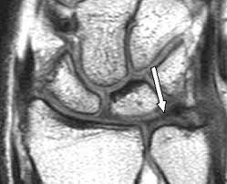 Athletes are at risk, especially those who use a racquet, bat or club or put pressure on the wrists. Triangular Fibrocartilage Tear Radsource