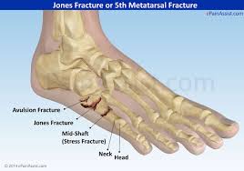 Well find out exactly how to get this bone feeling better! Pin By Sarah Iverson On Foot Jones Fracture Metatarsal Fracture Avulsion Fracture