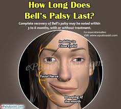 Most people begin recovery in 2 to 3 weeks, with 70% to 85% of people showing complete recovery in 2 to 3 months. How Long Does Bell S Palsy Last Bells Palsy Bell S Palsy Recovery Bell S Palsy