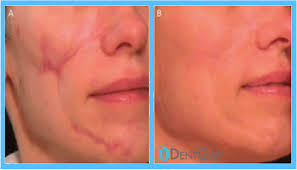 Laser scar removal before and after. Laser Scar Removal Facts Cost Does It Work