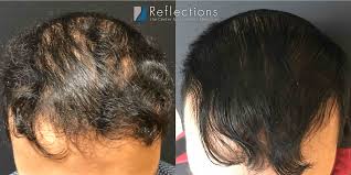 If hair follicles are damaged, the loss can be permanent. Hair Loss Treatments Near Me New Jersey Thinning Hair Price Cost