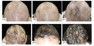 Alopecia totalis information and support guides covering causes, treatments, and an online support community for alopecia totalis sufferers. Clinical Changes In Alopecia Totalis With Body Hair Loss Susceptible To Download Scientific Diagram
