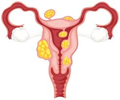 Operation fibrome arret de travail. Fibrome Uterin Symptomes Cause Traitement Operation