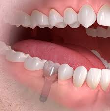 Maybe you would like to learn more about one of these? Dental Implants In Merseyside The Sandstone Dental Practice