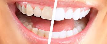 The zoom whitening procedure itself takes about an hour, but expect the entire appointment, including the exam, to take about 90 minutes, give or take. Zoom One Hour Chair Side Whitening System Pinehurst Dental