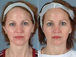Discover the best methods to begin treating wrinkles and keeping youthful skin. Botox Before And After Photos Philadelphia