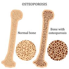 هشاشة العظام ترقق العظم Osteoporosis طبيب دوت كوم