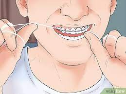 Food can easily get stuck between your child's braces. 3 Ways To Take Care Of Your Braces Wikihow