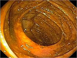 A colonoscopy poses few risks. 10 Questions You Need To Ask About Colonoscopy The New York Times