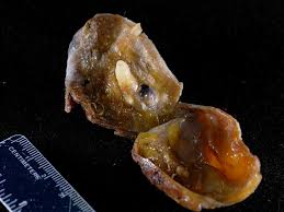 Dermoid ovarian cyst with hair and teeth pictures. Webpathology Com A Collection Of Surgical Pathology Images