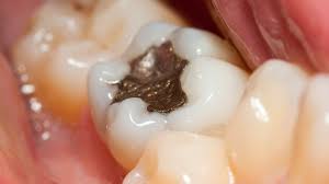 Check spelling or type a new query. Belfast Scientists Say Aspirin Could Reverse Tooth Decay Bbc News