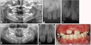Check spelling or type a new query. The Effect Of Early Removal Of Mesiodens For The Correction Of Central Incisor Rotation