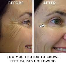How much does botox cost & how does it work? Five Botox Myths You Should Know About To Get A Better Result