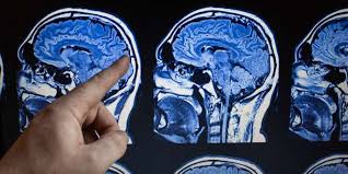 Neben dem gehirn (inkl.großhirn, kleinhirn, balken, thalamus, hypothalamus, brücke, medulla oblongata) gehören die augen, nase und nebenhöhlen, innenohr, mund und rachenraum sowie nerven, hypophyse, rückenmark und auch skelettanteile zum kopf. Mrt Des Kopfes