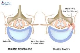 4 giai đoạn thoát vị đĩa đệm | Cách điều trị không cần phẫu thuật