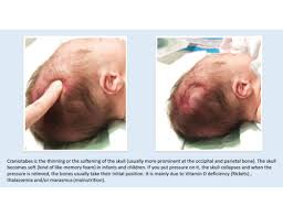 Image result for Craniotabes