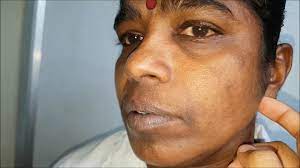 Browse the use examples 'chvostek sign' in the great english corpus. Chvostek Sign Youtube