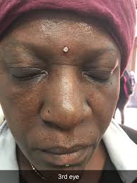 This chakra is located at the forehead between the eyes. Dermal On Forehead 3rd Eye