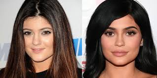 Her nose profile was a bit wider and its tip was also bigger in her before photo. Kylie Jenner Before And After Surgery Yve Style Com