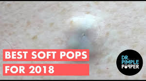 Best pimple popping videos pimple popping compilation огромные прыщи в ушах выдавливание прыщей. The Best Of Softpops 2015 For 2018 Dr Pimple Popper Youtube